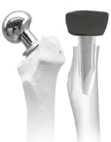Bipolar and Radial Head Prosthesis