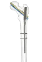 intramedullary nail